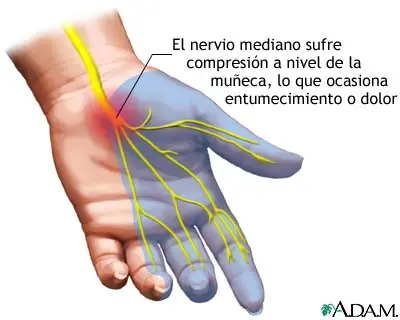 Dolor de muñeca