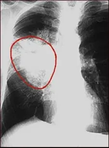 Cancer de pulmon en imagenes.
