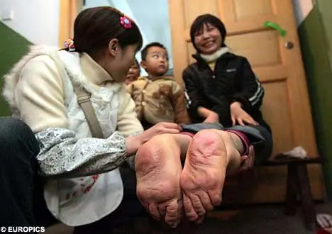 Nació con los pies al revés!!