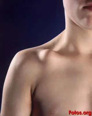 Fractura de clavicula