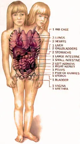 Adolescente de dos cabezas.
