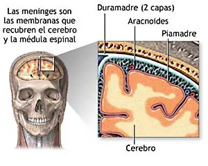 Meningitis: Lo Que Debemos Saber - Ojo!