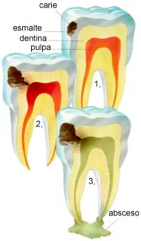 Caries