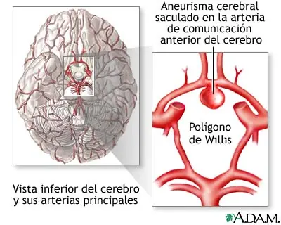 Aneurisma.