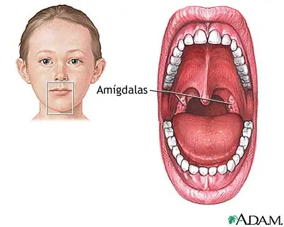 Amigdalectomía (imagenes).