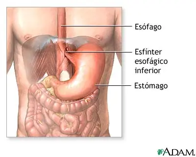 Reflujo gastroesofágico (imagenes)