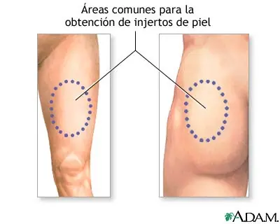 Injerto de piel.