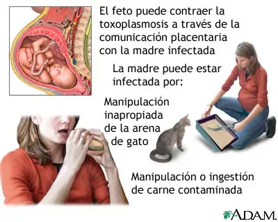 Toxoplasmosis.