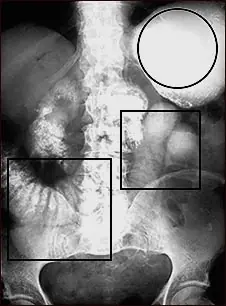Oclusion intestinal.
