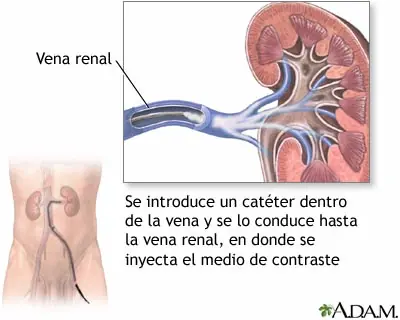 Venografía renal