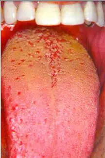 Pautas contra la halitosis y la sequedad bucal