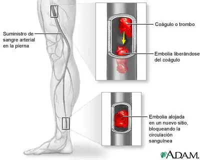 Embolia arterial