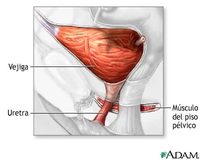 incontinencia urinaria de esfuerzo en las mujeres (cirugia)