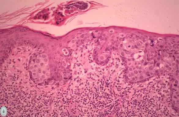 Nuevos sintomas del cancer de mamas