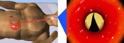 Gastritis