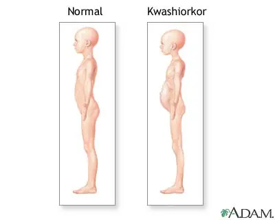 Kwashiorkor (ingesta inadecuada de proteinas)
