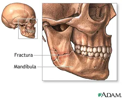 Fractura o luxación mandibular
