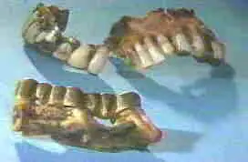 La pésima dentadura de Hitler.