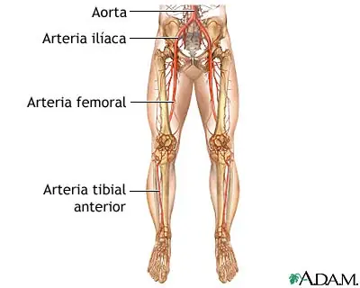Arterioesclerosis de las extremidades