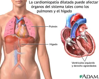 Miocardiopatía dilatada