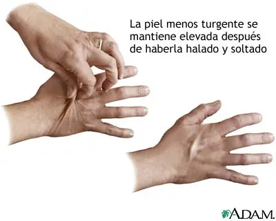 Turgencia cutánea