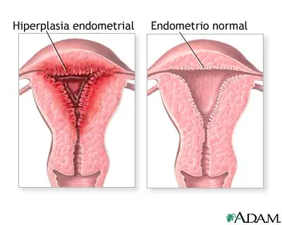Períodos menstruales profusos, prolongados o irregulares