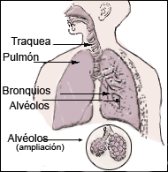 La Pulmonia