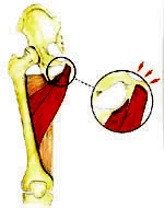 Pubalgia.