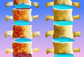 Menopausia y osteoporosis