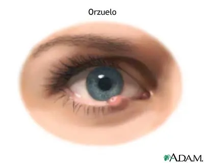 Orzuelo.