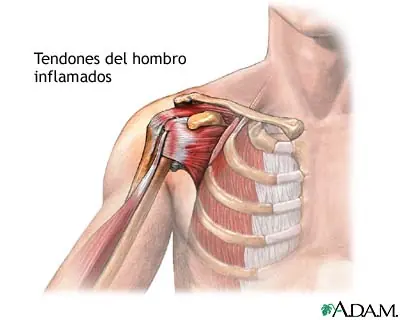 Tendinitis del manguito de los rotadores