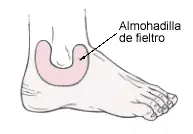 Torceduras del tobillo: curando y previniendo lesiones