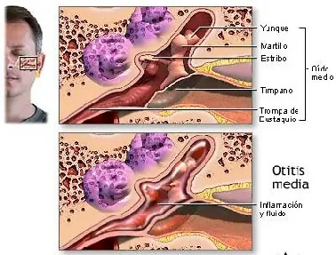 Infecciones de oído: otitis media con derrame