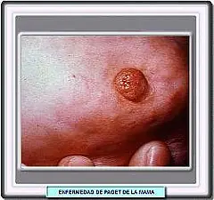 Nuevo Cancer Mamario - Patologia Lepidoptera y Paget