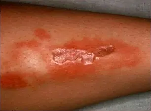Infección necrosante de tejidos blandos