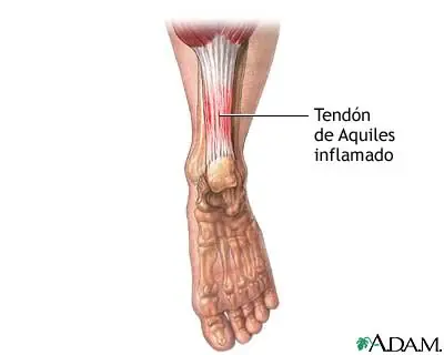 Tendinitis aquílea