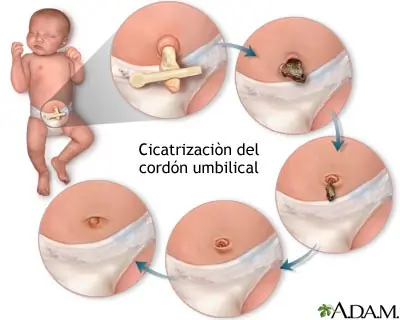 Cuidado del cordón umbilical en recién nacidos