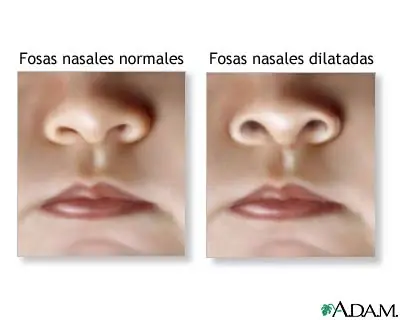 Aleteo nasal