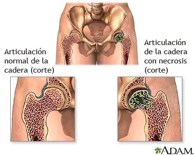 Necrosis aséptica