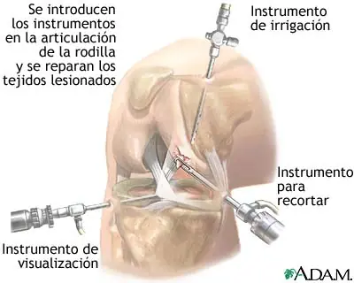 Ruptura de menisco