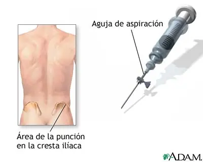 Biopsia de lesión ósea