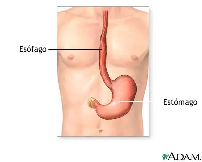 Inserción de una sonda de gastrostomía