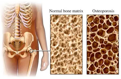 Osteoporosis --cuidemos los huesos