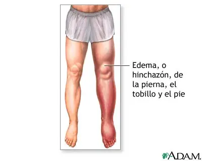 Hinchazón de tobillos, pies y piernas (edema periferico)