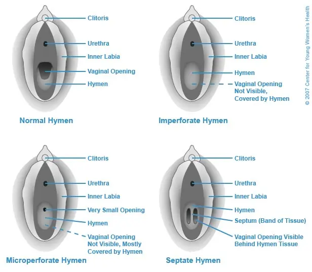 tipos de himen