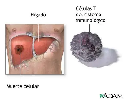 Absceso hepático amebiano