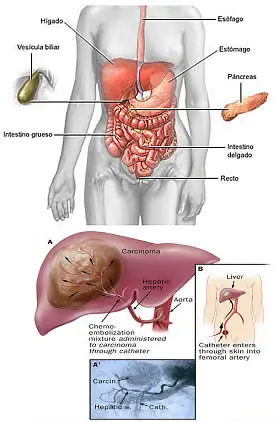 Cancer de Higado