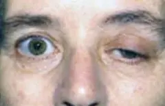 La miastenia gravis, una extrema debilidad muscular
