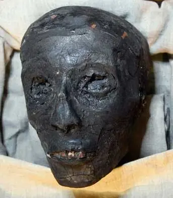 Tutankamón murió a causa de una fractura agravada...