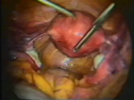 Qué es la endometriosis